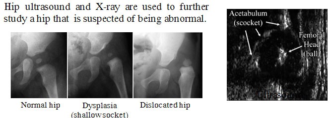 abnormal hip x ray